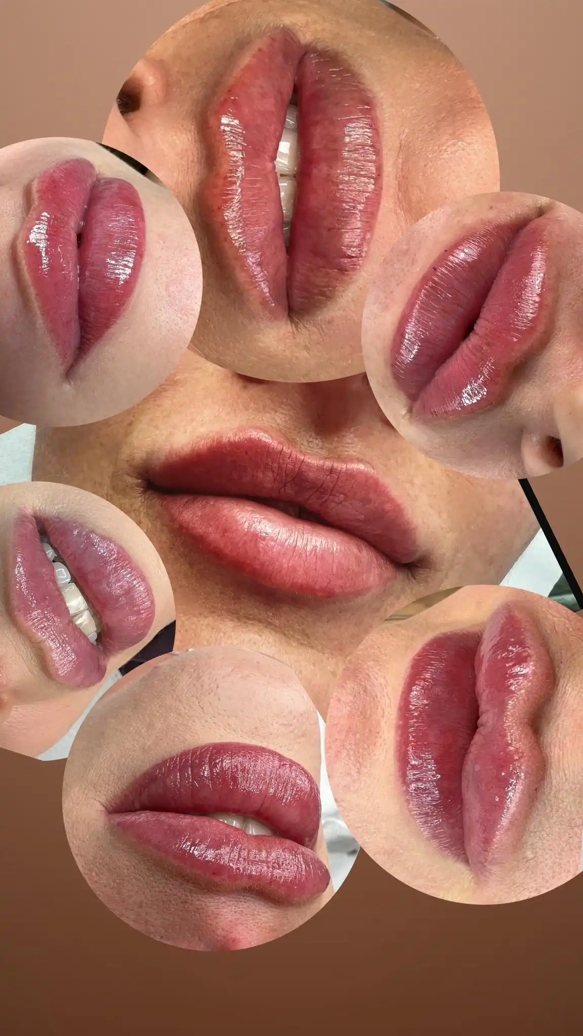 Depilacja laserowa i RF mikroigłowa – Hello Beauty Kołobrzeg