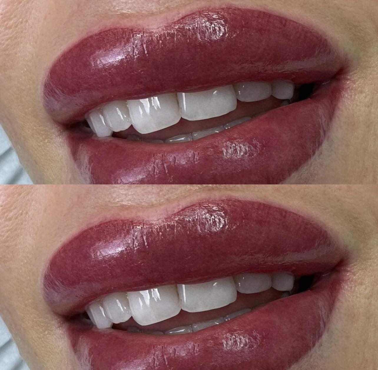 Usta permanentne – realizacja 1