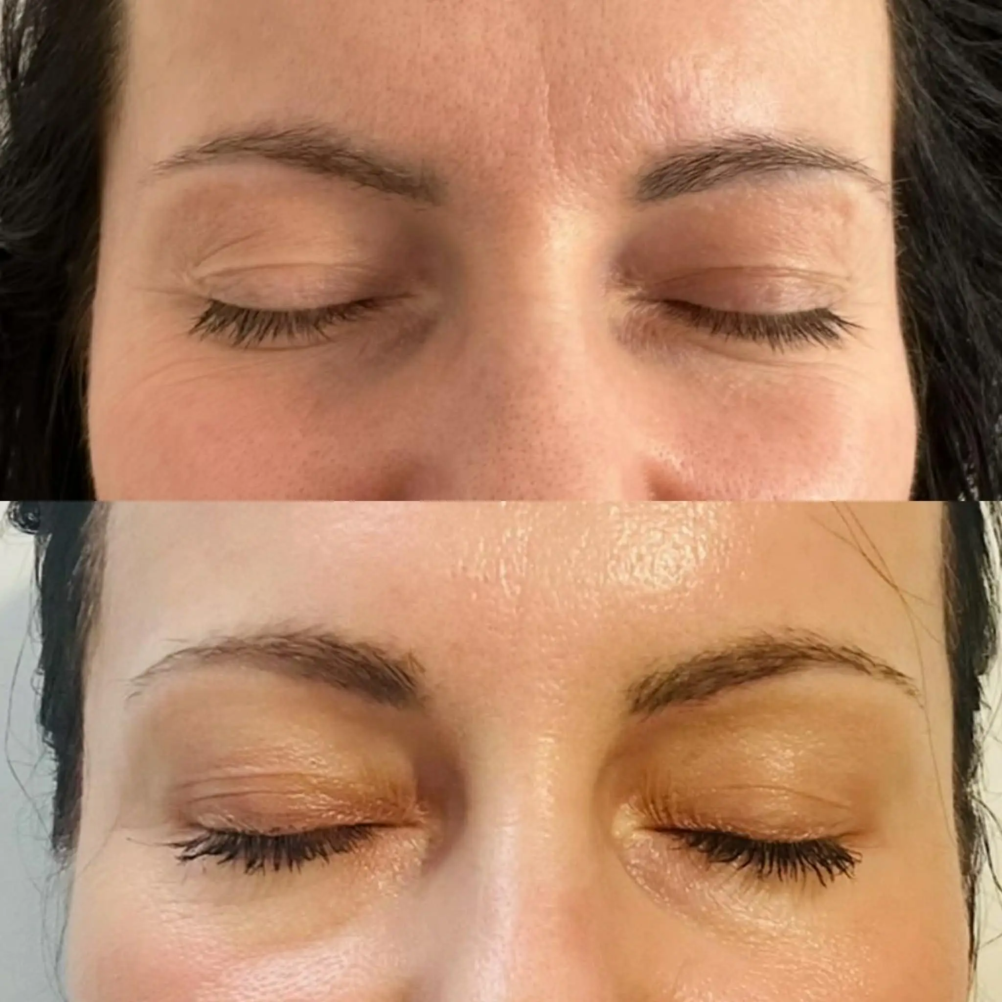 Laser tulowy efekt po pierwszym zabiegu – Hello Beauty Kołobrzeg