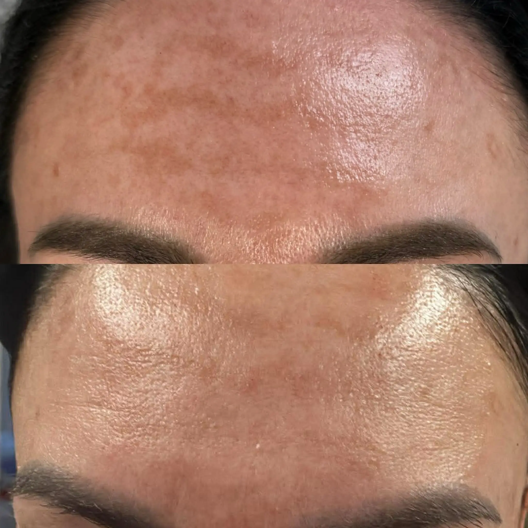 Radiofrekwencja mikroigłowa przed i po – Hello Beauty Kołobrzeg