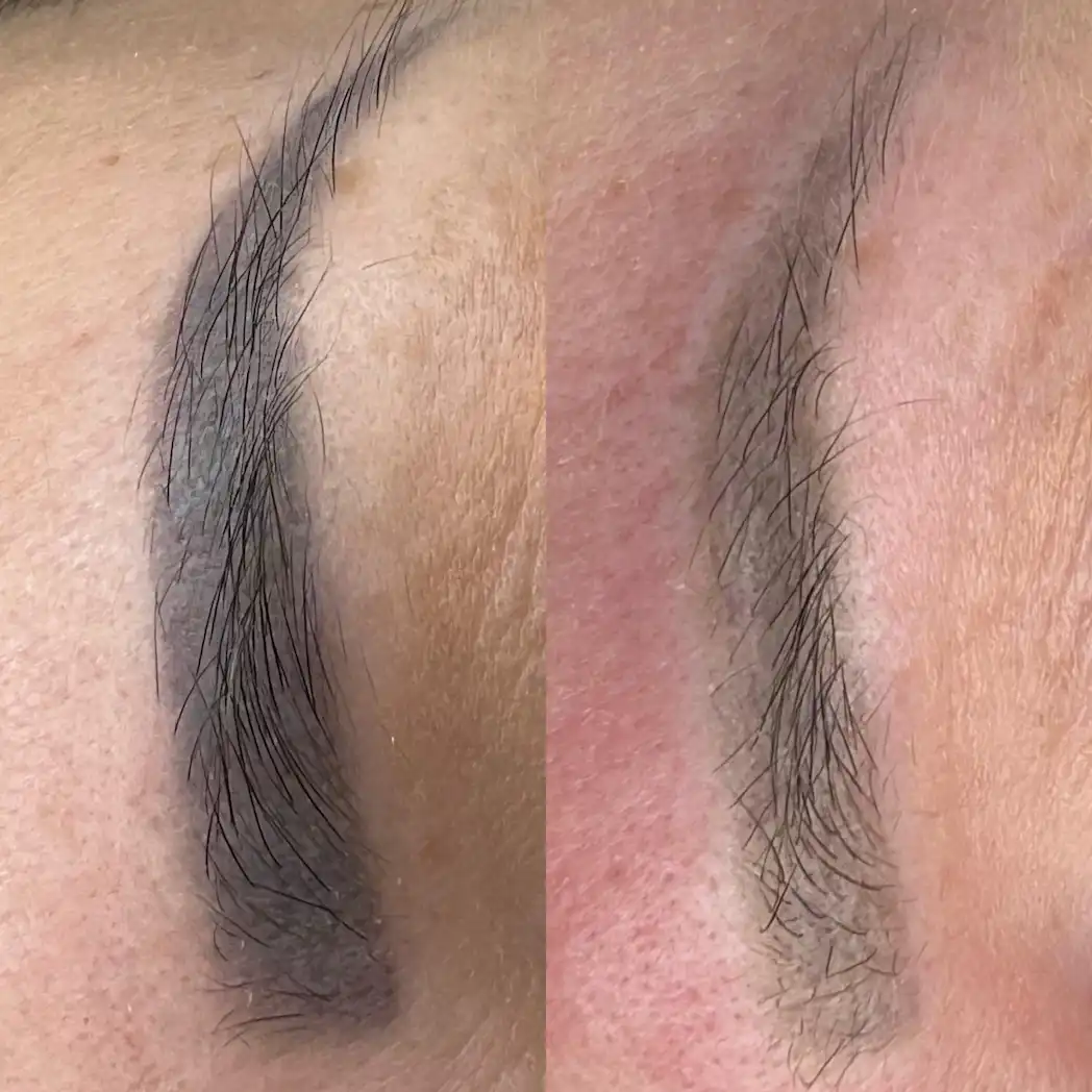 Usuwanie brwi PMU przed i po – Hello Beauty Kołobrzeg